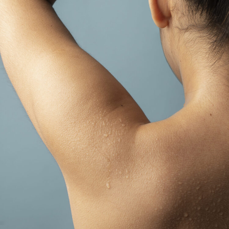 hiperhidrosis