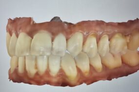 TAC Intraoral