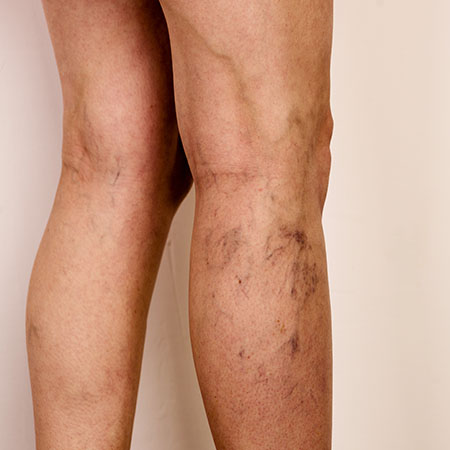Esclerosis de Varices